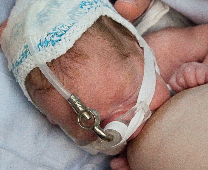Billedet viser en baby med næsesonde der ammes.
