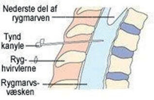 Illustrationen viser hvor på rygmarven, og hvor dybt i marven, kanylen indføres.