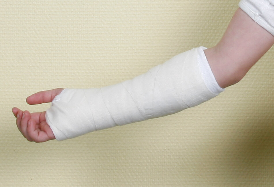 Billedet viser en arm i gips.