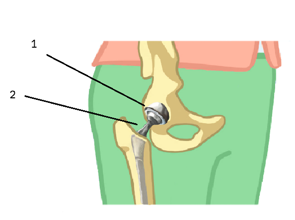 Illustrationen viser, at en hofteprotese består af to dele nemlig protese-delen i hofteskålen og protese-delen, der består af en lårbenshals med ledhoved, som fæstnes i lårbenet.