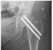 Billedet viser et røntgenbillede af pinde sat ind i hoften.