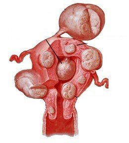 Illustrationen viser fibromer på livmoderen.