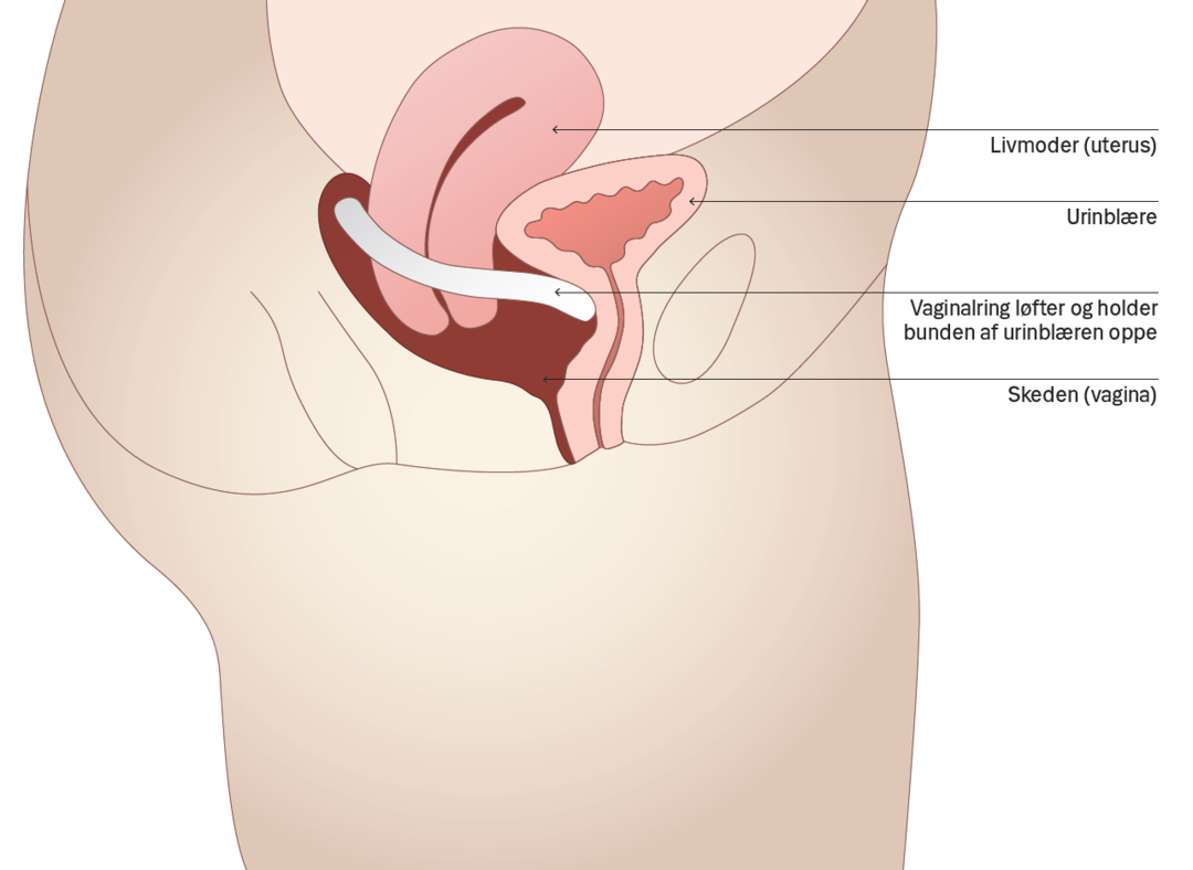 Vaginalringens placering i skeden.