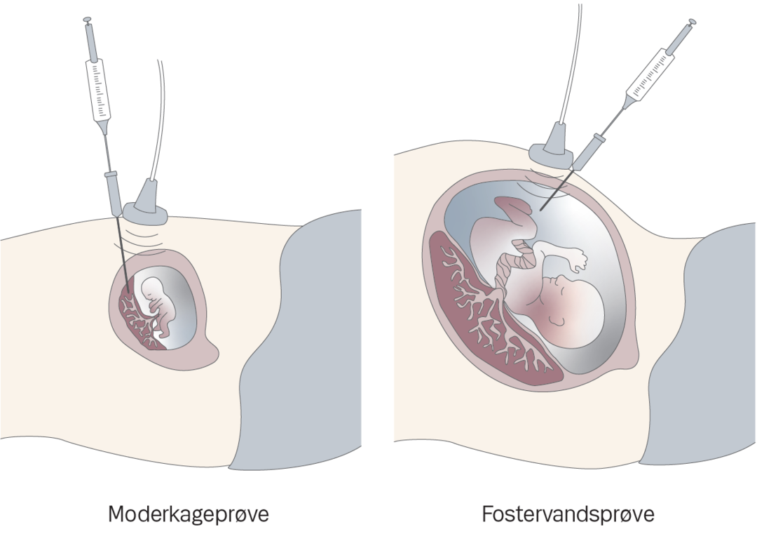 Illustration af en moderkageprøve og en fostervandsprøve