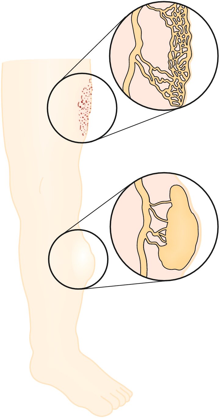 Illustration af lymfatisk malformation