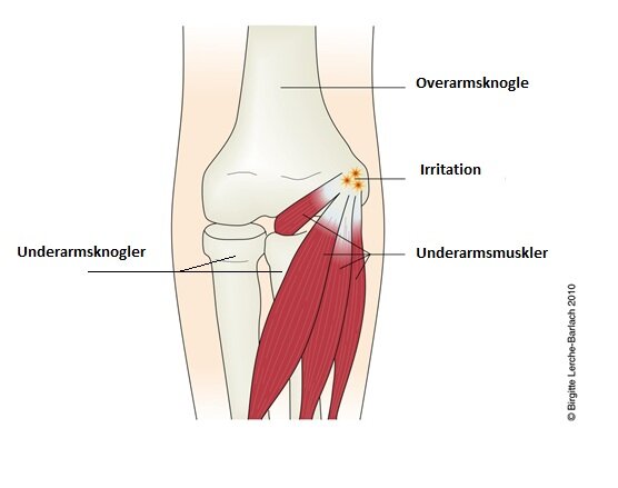Illustration af tennisalbue. Viser underarmsknoglerne, overarmsknoglen, underarmsmuskler og irritation hvor musklerne er fæstnet til overarmsknoglen