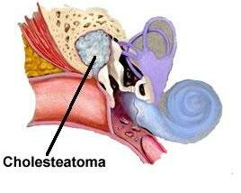 Billedet viser Cholesteatoma