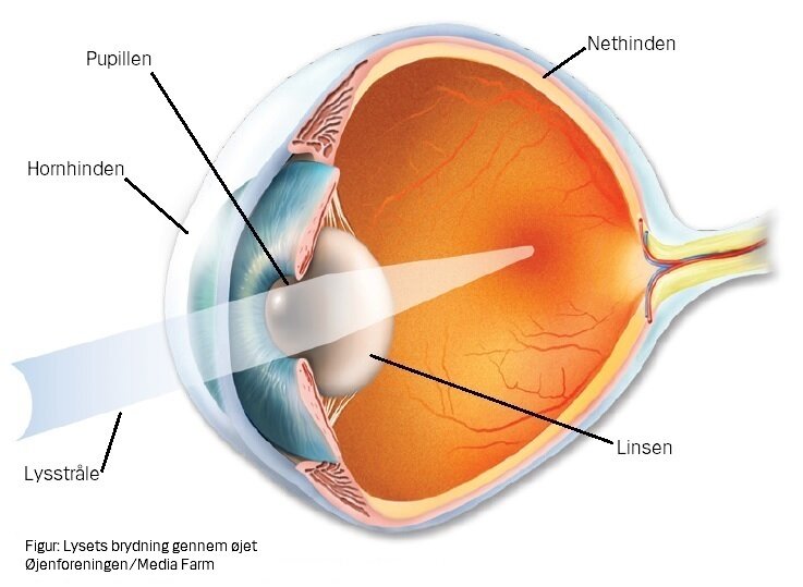 Bi stun nuttet Brydningsfejl i øjet - operation