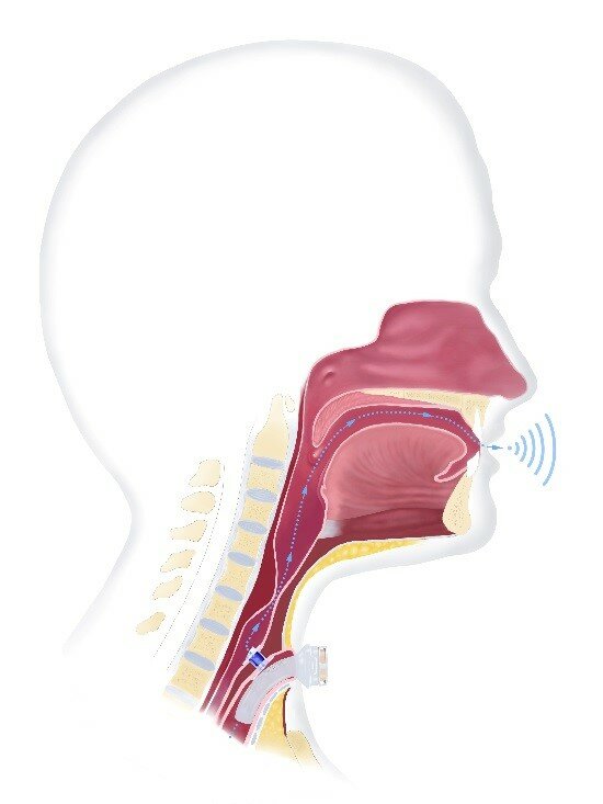 Billedet viser indoperere en taleventil (Provox ventil)