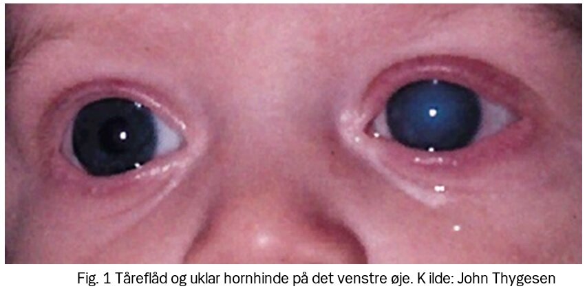 Grøn stær (glaukom) hos børn