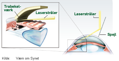 Ved SLT-laserbehandling afsættes energien i trabekelstrukturerne i kammervinklen