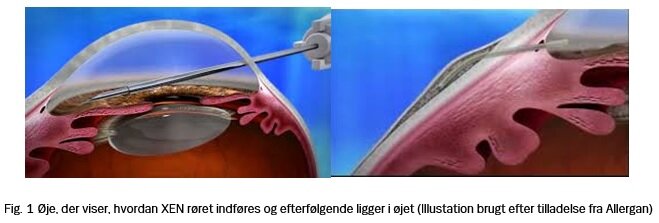 Figur 1: Øje, der viser, hvordan XEN røret indføres og efterfølgende ligger i øjet
