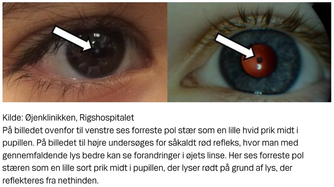På den ene billede ses forreste pol stær som en lille hvid prik midt i pupillen. På det andet billede undersøges for rød refleks, hvor man med gennemfaldende lys bedre kan se forandringer i øjets linse.