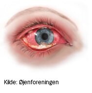 Betændt øje pga. infektion med adenovirus
