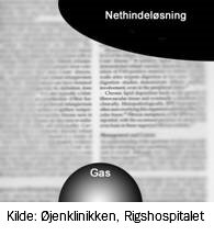 Nethindeløsning som patienterne ser: de ser meget sløret
