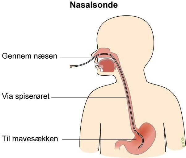 Figur af hvordan nasalsonden føres gennem næsen, ned gennem spiserøret og ned i mavesækken.
