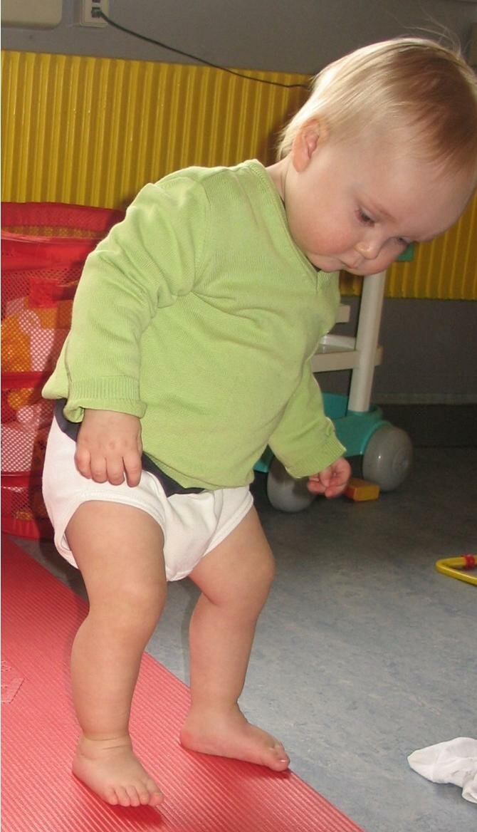 Billede af baby med klumpfod