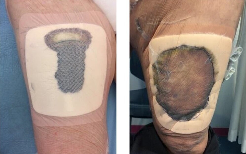 Donorsted på låret, som er forbundet med en sugende skumbandage.
