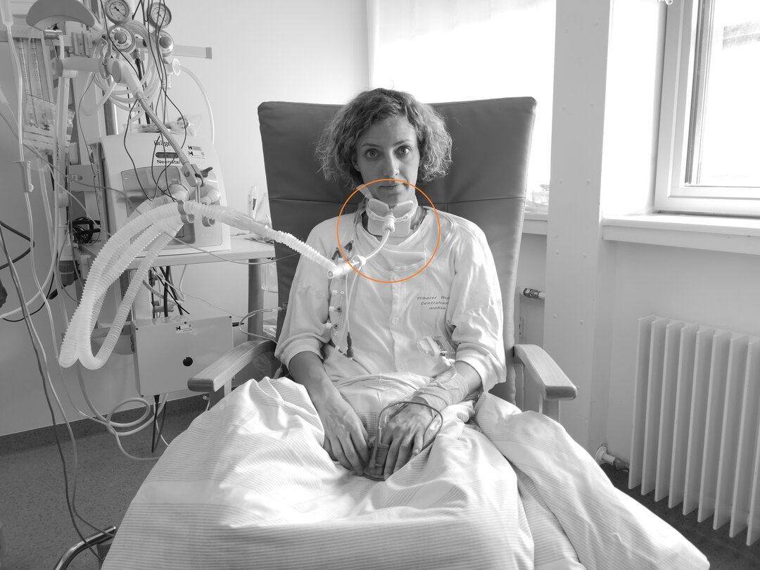 På billedet ses en patient med en trakeotomi.