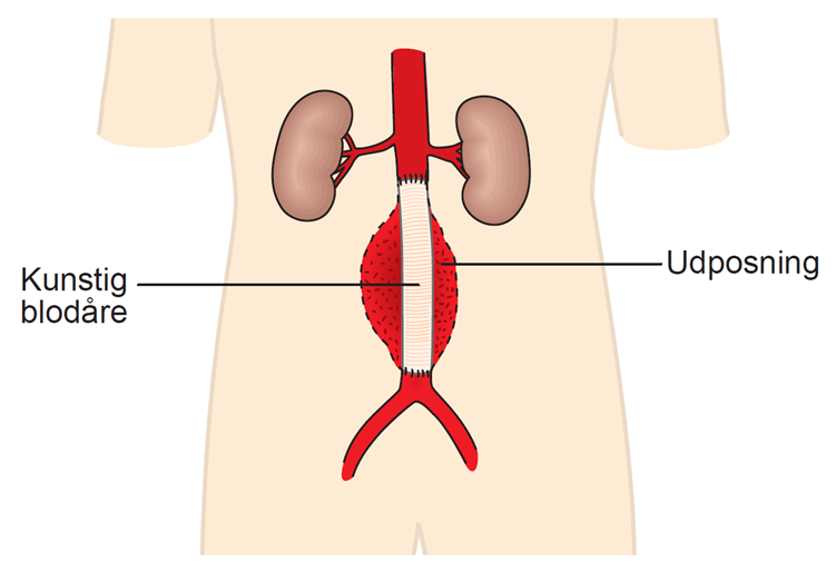 Illustration af en udposning på hovedpulsåren og en kunstig blodåre