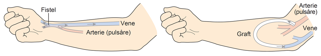 Illustration i to billeder. Første billede af en fistel i armen, andet billede af en graft i armen