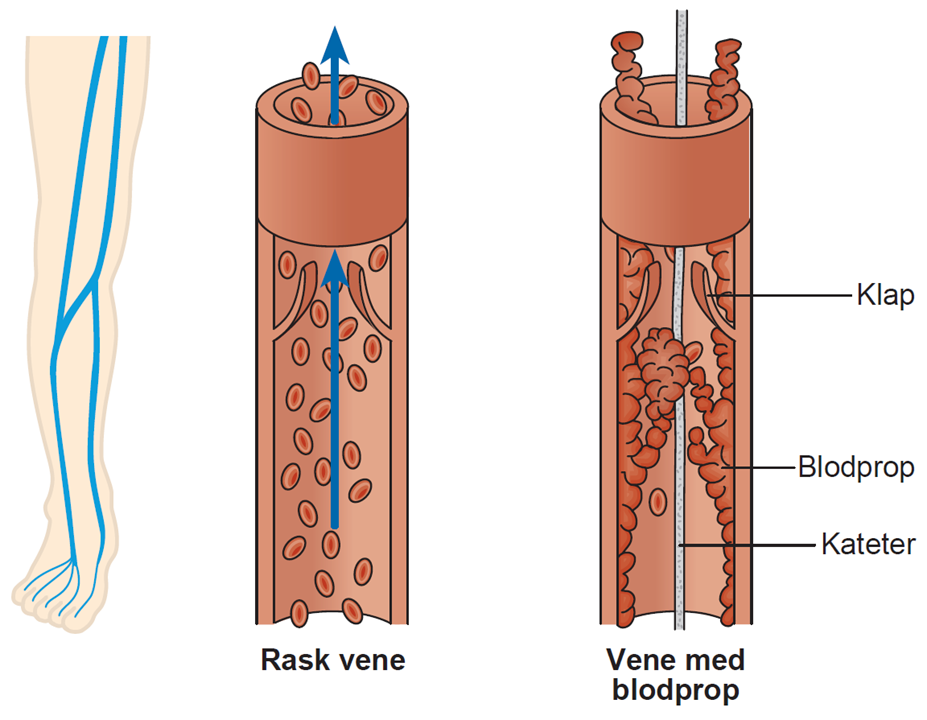 Illustration af en rask vene og en vene med blodprop