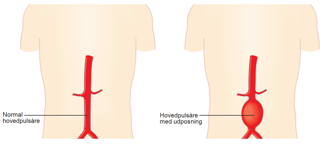 Illustration af en normal hovedpulsåre og en hovedpulsåre med udposning