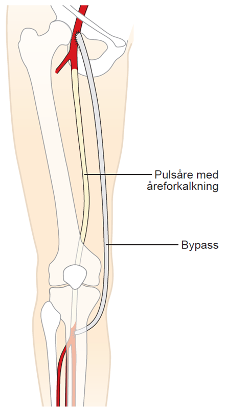 Illustration af bypassoperation i benet