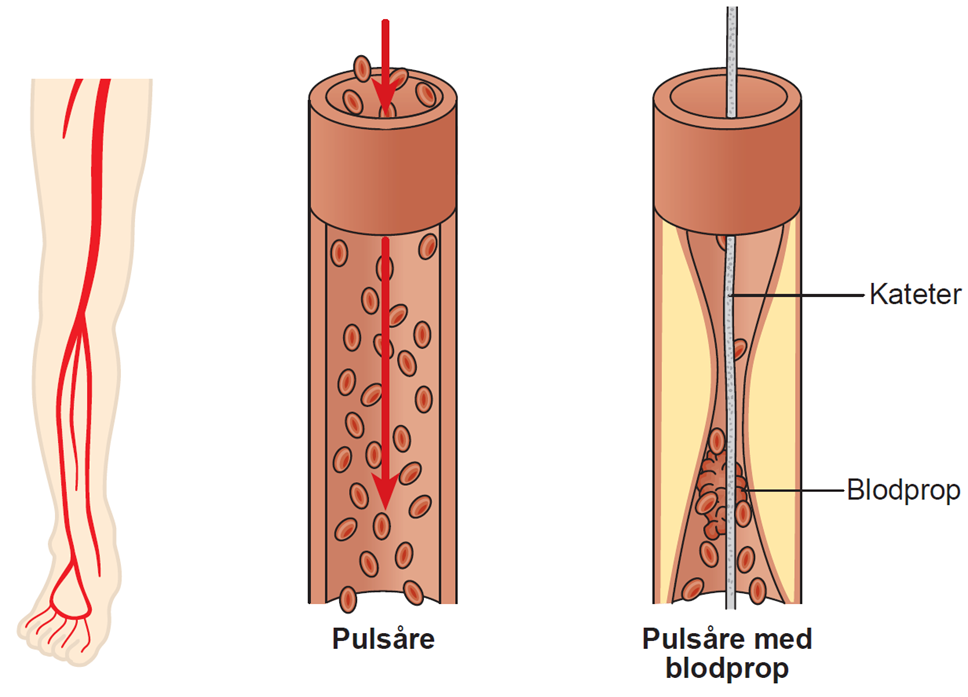 Illustration af en rask pulsåre og en pulsåre med blodprop