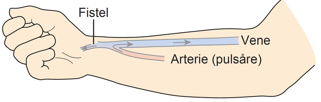 Illustration af en AV-fistel