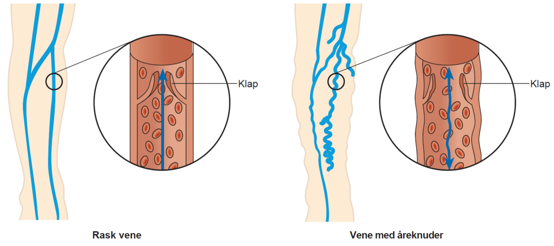 Illustration af en rask vene og en vene med åreknuder