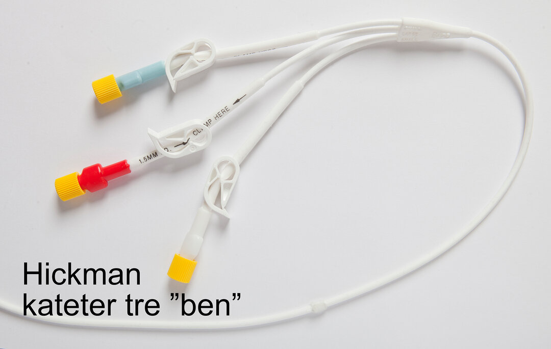 Hickman kateter tre ben