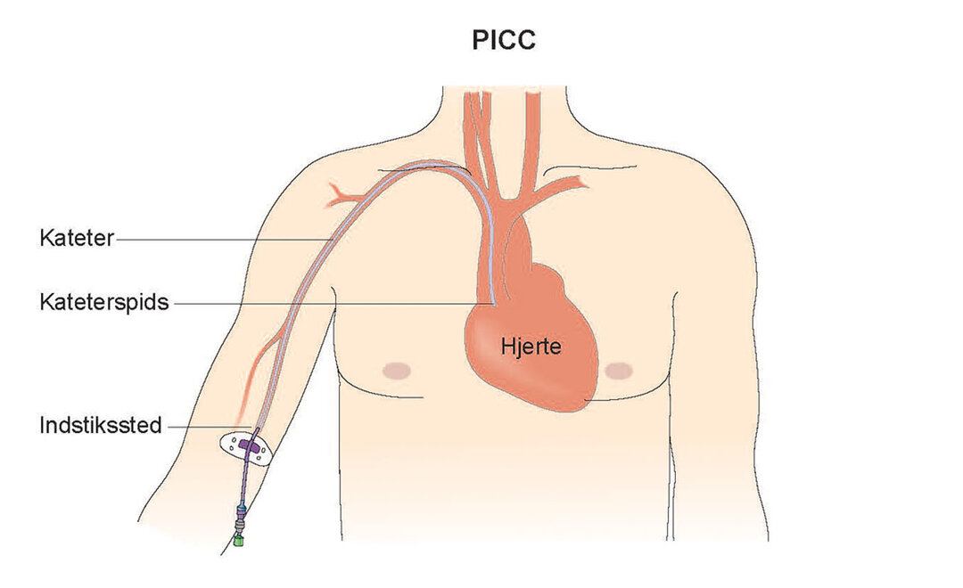 Billedet viser et centralt venekateter, også kaldet PICC