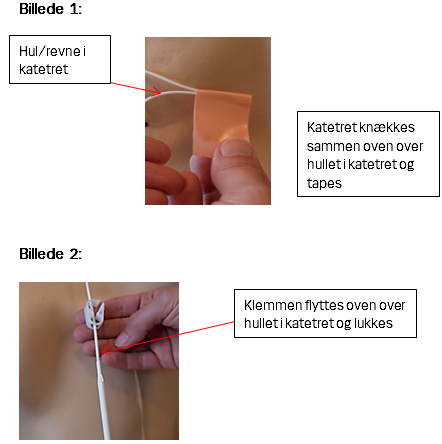 Billede 1 viser, at katetret knækkes sammen oven over hullet i katetret og tapes. Billede 2 viser, at klemmen flyttes oven over hullet i katetret og lukkes.