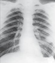 Røntgenfoto af lunger