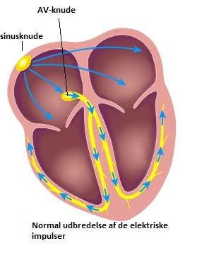 Billedet viser normal udbredelse af de elektriske impulser, AV-knude samt sinusknude