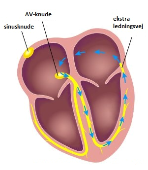 Billedet viser sinusknude, AV-knude samt ekstra ledningsvej i hjertet