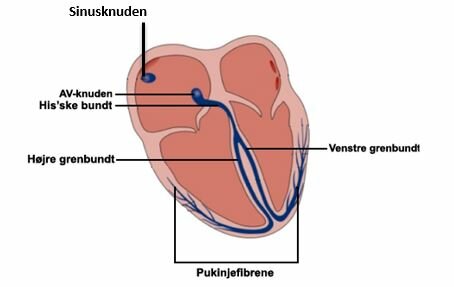 Billedet viser et normalt hjerteslag starter ved en impuls fra sinusknuden 
