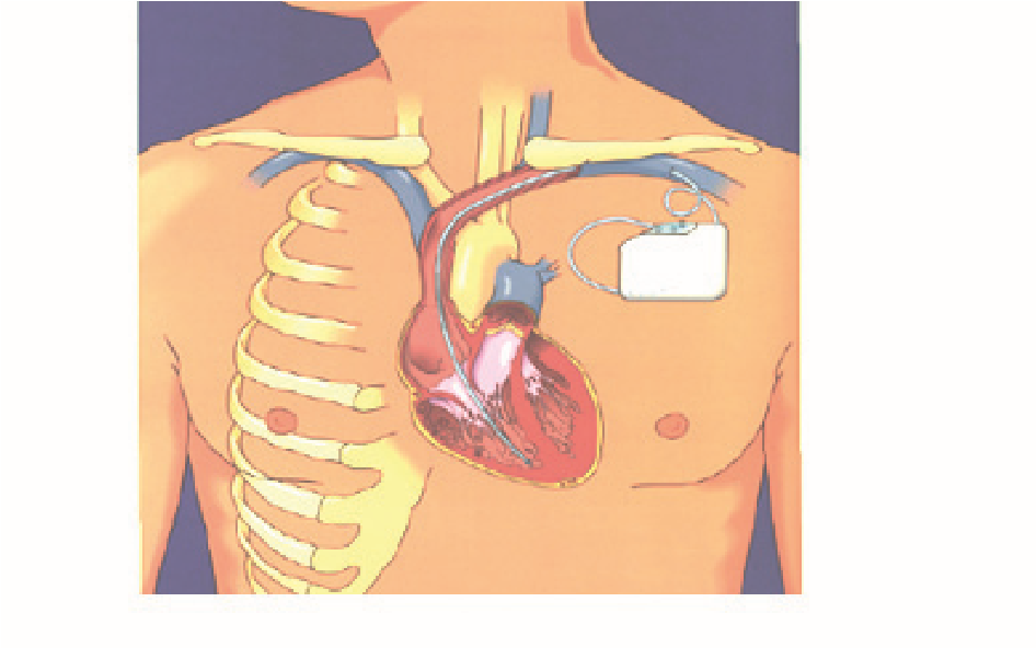 Billeder viser et hjerte med en ICD