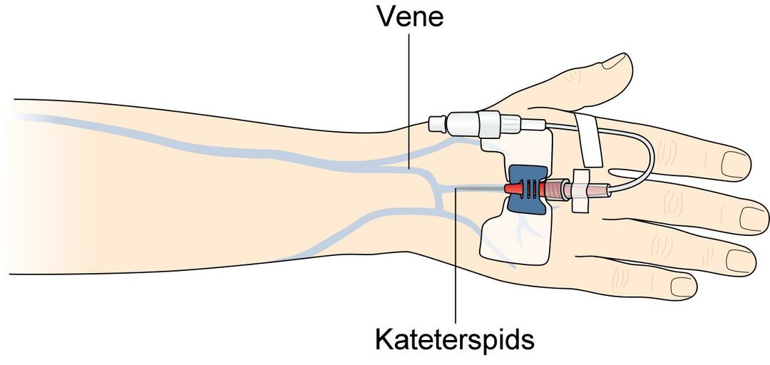 Perifert Vene Kateter PVK Perifert Vene Kateter PVK