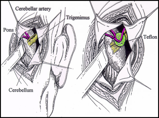 Trigeminusneuralgi - operation for