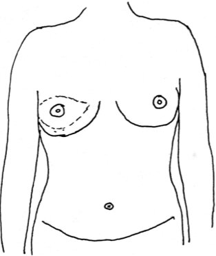 Brystet formes af vævet (lap) fra maven.