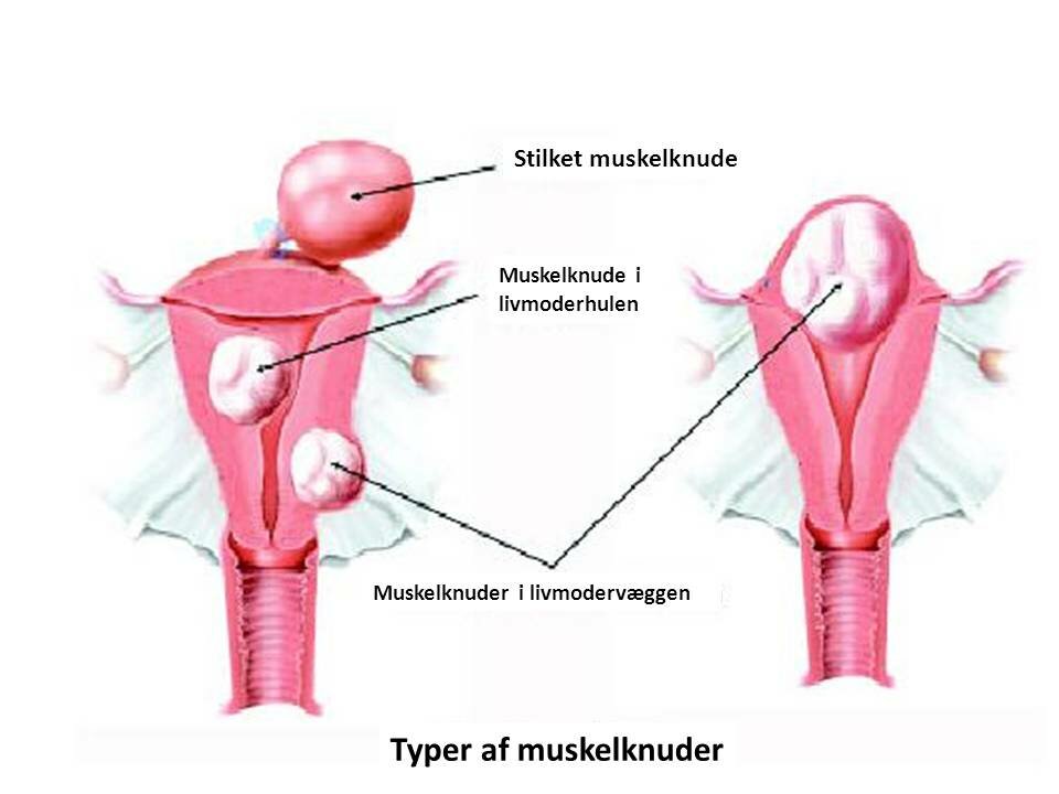 Illustration af typer af muskelknuder. Der er stilket muskelknude, muskelknude i livmoderhulen og muskelknuder i livmodervæggen.