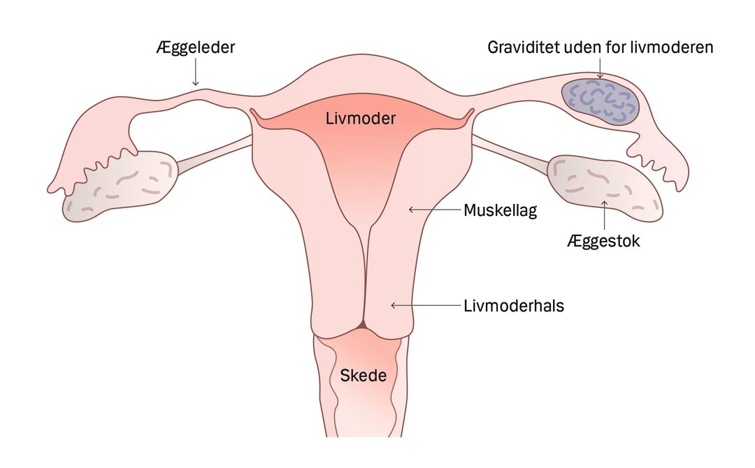 Illustration af graviditet uden for livmoderen