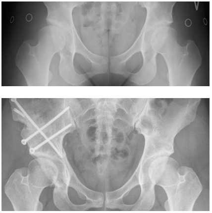 Røntgenbillede før og efter operation