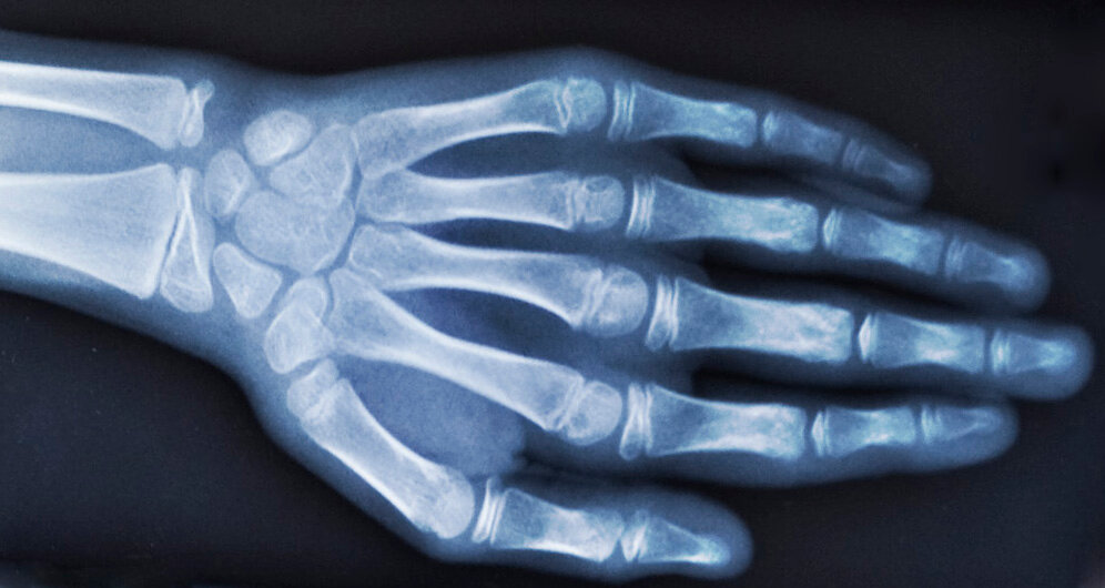 Røntgenbillede af venstre hånd.