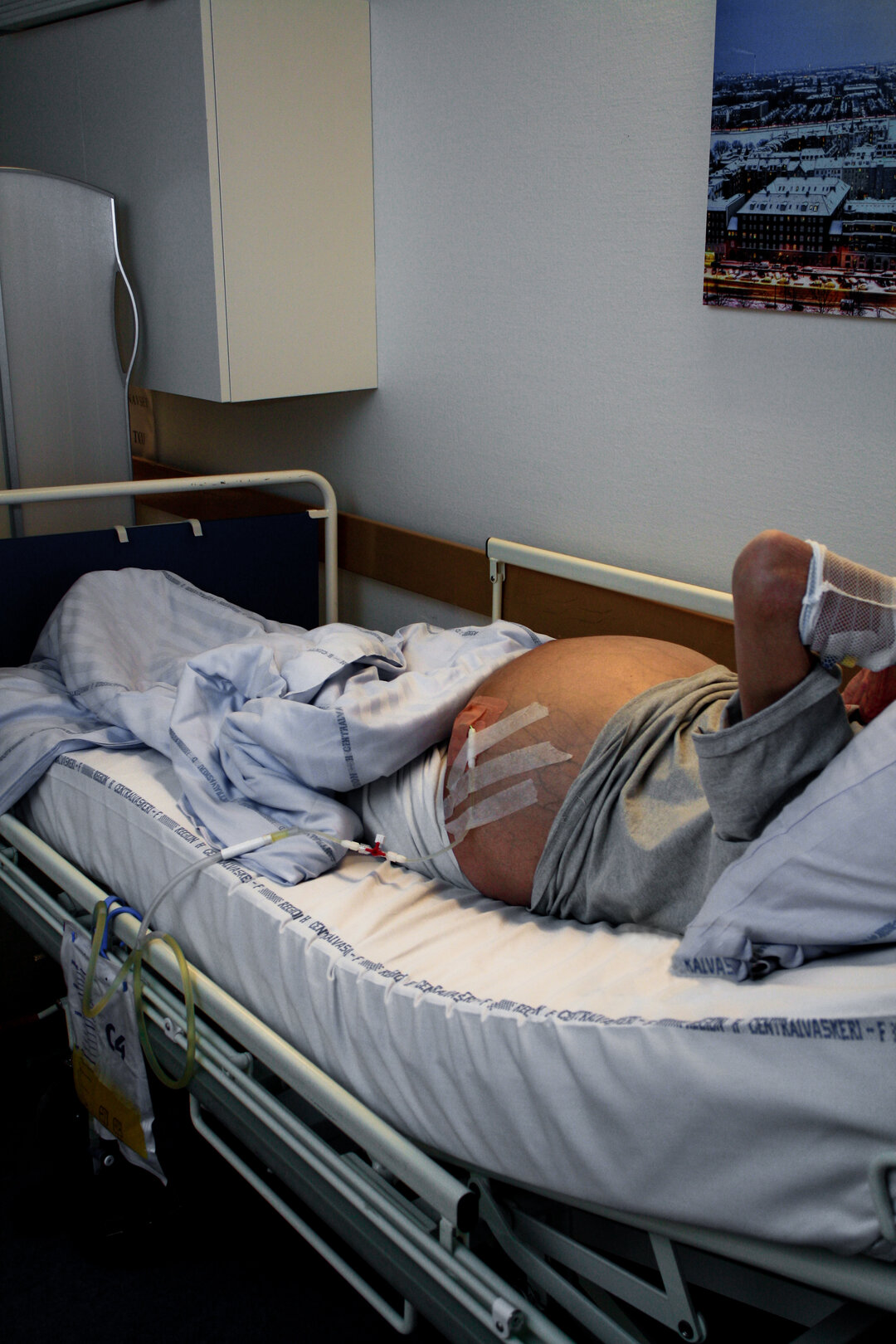 Ascitestapningen foregår i patientens egen seng på afsnittet