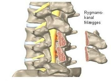 Rygmarvskanal frilægges