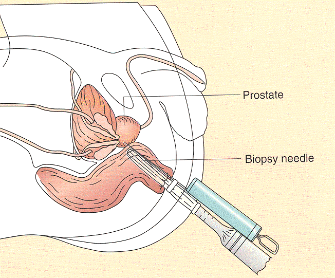 Biopsi af prostata