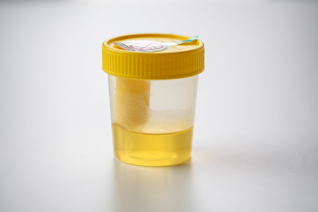 Foto af urinkop med urin i.